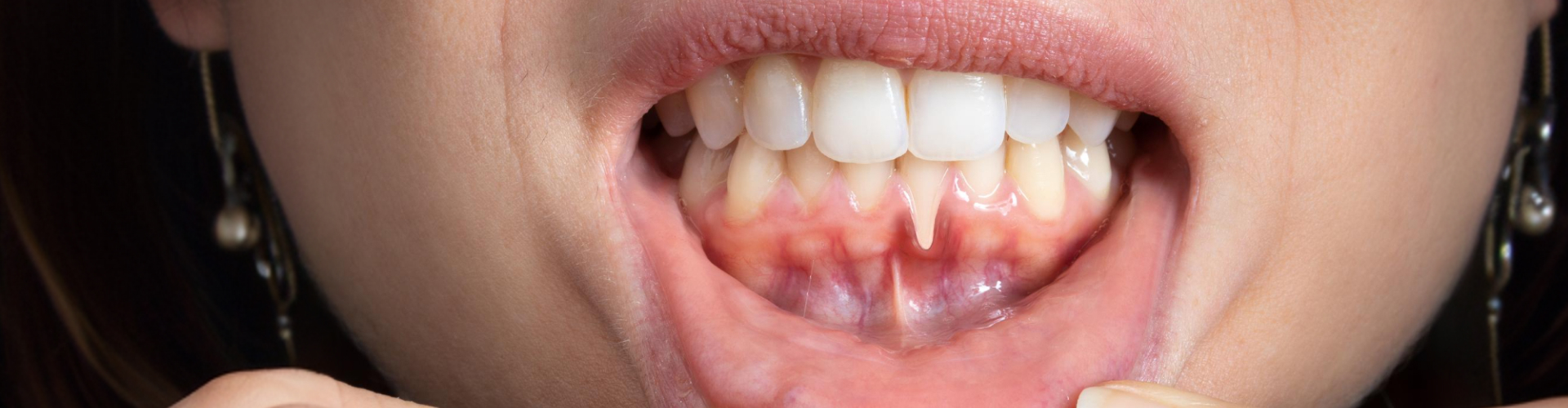 Close-up of lower front teeth with gum recession and an exposed tooth root.